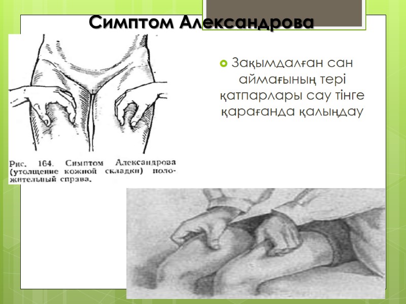 Зақымдалған сан аймағының тері қатпарлары сау тінге қарағанда қалыңдау Симптом Александрова